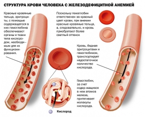 Причины возникновения, симптомы анемии у детей, лечение
