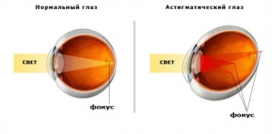 Детский астигматизм