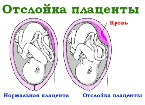 Отслойка плаценты